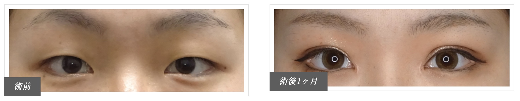 二重整形おすすめクリニック切開法画像引用東京中央美容外科